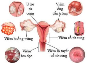 Viêm Bộ Phận Sinh Dục Nữ Nguyên Nhân, Dấu Hiệu, Chẩn Đoán, Điều Trị
