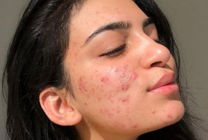 6 Bước Chăm Sóc Mụn Đầu Đen Cho Da Dầu Nhạy Cảm Hiệu Quả, Ít Tốn Kém Tại Nhà