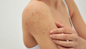 Bị Mụn Ẩn Ở Cánh Tay Có Nguy Hiểm Không ?