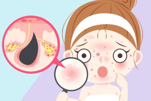 Điều Trị Mụn Ẩn Trên Trán An Toàn, Hiệu Quả Nhanh Chuẩn Y Khoa Sau 1 Tuần