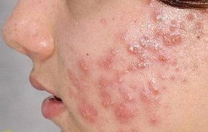 Bí Mật 8 Chăm Sóc Mụn Cho Da Khô Ở Cổ Hiệu Quả Nhanh Chóng