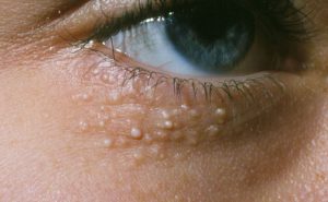 Điều Trị Mụn Ẩn Ở Dưới Mắt Có Gây Nguy Hiểm Hay Không