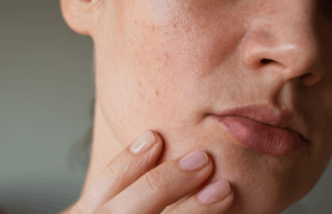 Bí Mật 4 Cách Chăm Sóc Da Mụn Và Bít Tắc Lỗ Chân Lông Ở Da Khô Tại Nhà