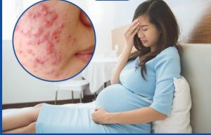  Mẹo Chăm Sóc Mụn Cho Da Khô Ở Phụ Nữ Mang Thai An Toàn