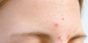 Cách Chăm Sóc Mụn Mủ Da Khô Ở Trán Tại Nhà Phục Hồi Nhanh Chóng