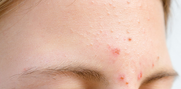 Cách Chăm Sóc Mụn Mủ Da Khô Ở Trán Tại Nhà Phục Hồi Nhanh Chóng