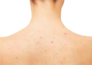 Cách Điều Trị Mụn Nang Ở Lưng Đơn Giản Hiệu Quả Tại Nhà Sao Bước