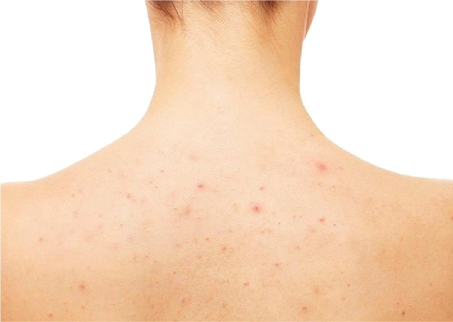 Cách Điều Trị Mụn Nang Ở Lưng Đơn Giản Hiệu Quả Tại Nhà Sao Bước