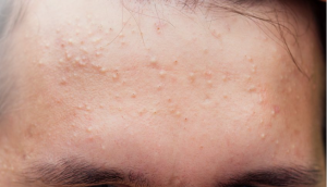 Cách Chăm Sóc Mụn Mủ Da Khô Ở Trán Tại Nhà Không Để Lại Thâm Sẹo