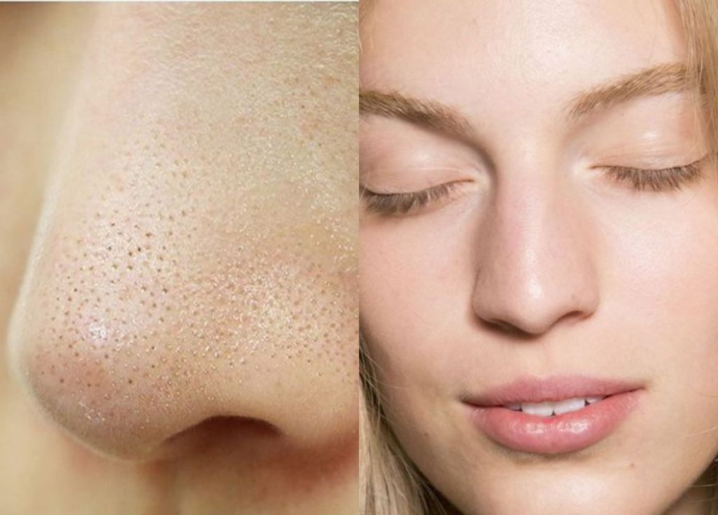 Mẹo Chăm Sóc Mụn Cám Cho Da Dầu Các Bạn Gái Nên Thử.