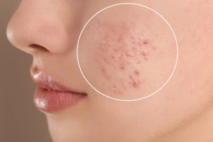  Bí mật 6 chăm sóc mụn trứng cá da khô phổ biến mới nhất hiện nay Mà bạn chưa biết.