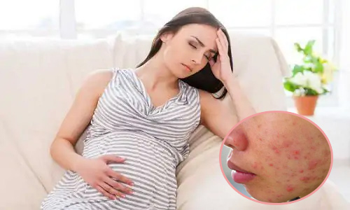 Điều Trị Mụn Ẩn Ở Phụ Nữ Mang Thai An Toàn Hiệu Quả Theo Bác Sĩ Da Liễn Sau 1 Tuần