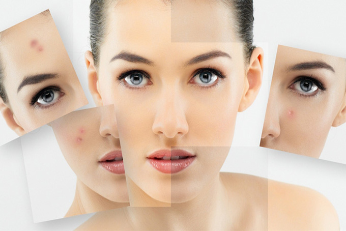 Bật Mí Điều Trị Mụn Ẩn Dưới Da Đơn Giãn Ít Tốn Kém Tại Nhà Sau 1 Tuần