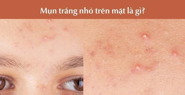 Cách Điều Trị Mụn Đầu Trắng Quanh Mặt Hiệu Quả Siêu Tốc Chuẩn Y Khoa