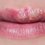 Cách Điều Trị Mụn Rộp Ở Môi Đơn Giản Và Phổ Biến Nhất Mà Bạn Chưa Biết Hiện Nay