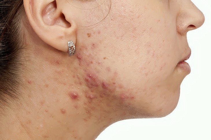 Điều Trị Mụn Ở Dưới Cổ Đúng Cách Hiệu Quả Không Gây Thâm Sẹo