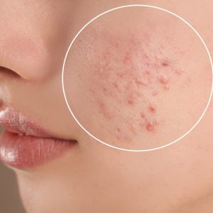 Điều Trị Mụn Đầu Trắng Và Bít Tắc Lỗ Chân Lông Tại Nhà Phục Hồi Nhanh Chóng