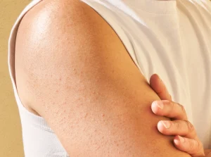 Điều Trị Mụn Đầu Trắng Ở Cánh Tay Đơn Giản Giúp Bạn Nữ Tự Tin Hơn