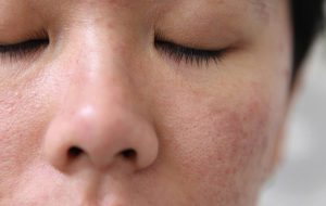 Cách Điều Trị Viêm Nang Lông Các Bạn Gái Nên Thử Sạch Viêm Sau 5 Ngày